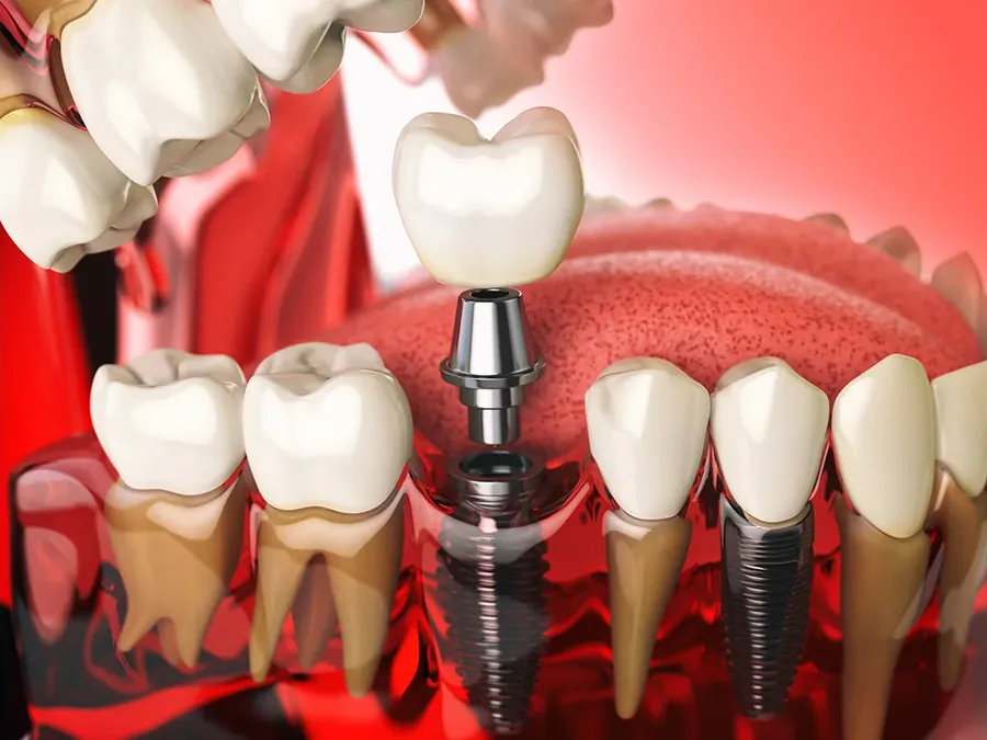 3D implant planlama